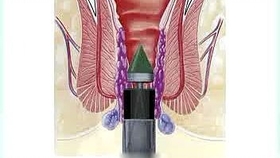 揭秘痔瘡手術(shù)價格真相，費用分析與參考指南
