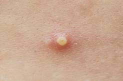 祛疣資訊，開啟疣的告別之旅