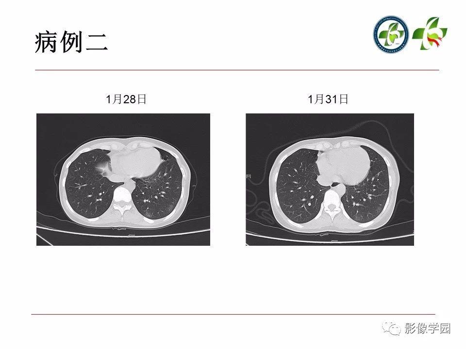 最新肺部感染病例探討及某某觀點(diǎn)分析