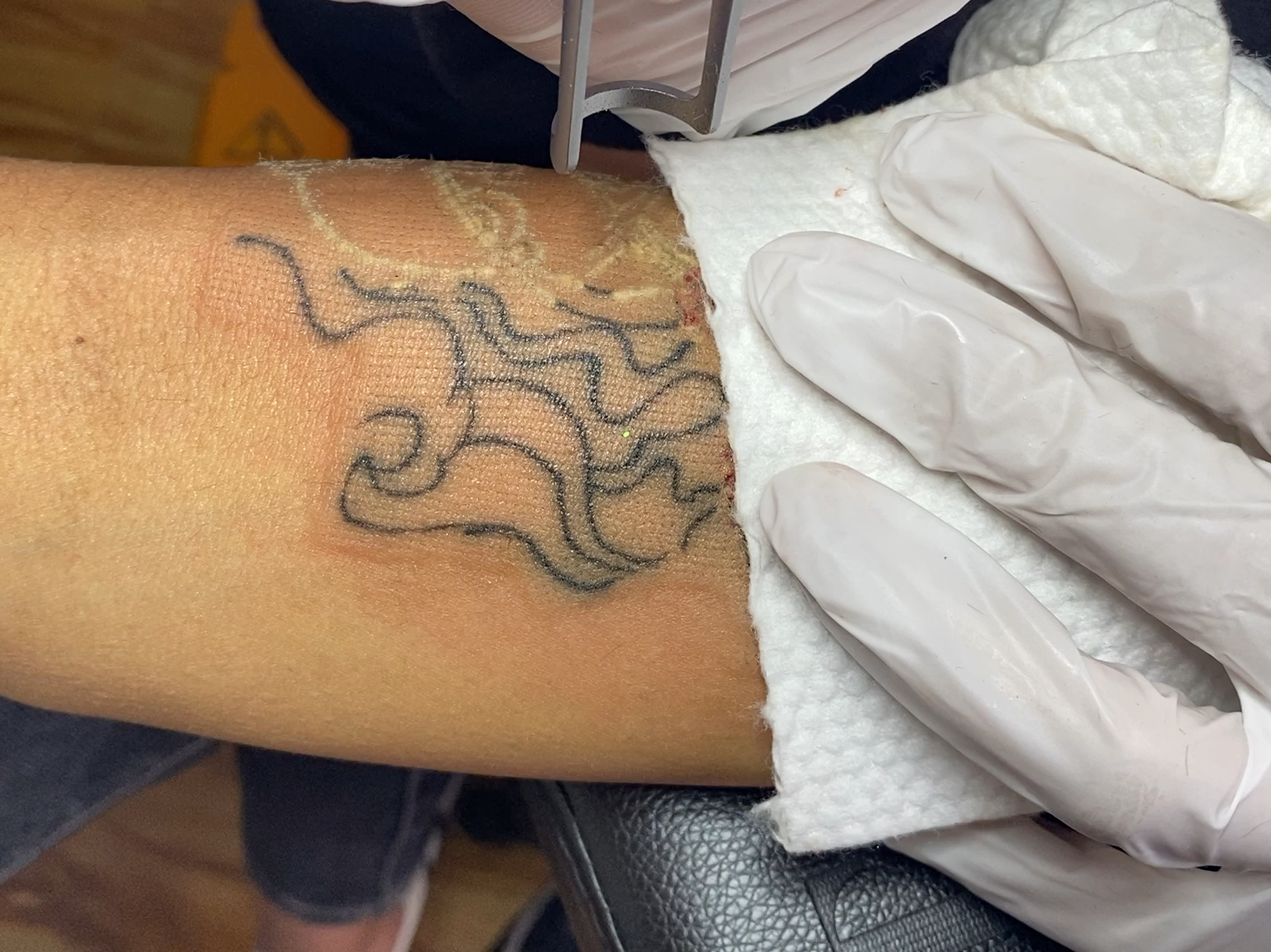 最新洗紋身技術(shù)及其觀點(diǎn)論述